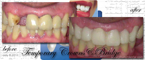 Temporary Crowns&Bridges at Phuket Dental Clinic,Thailand